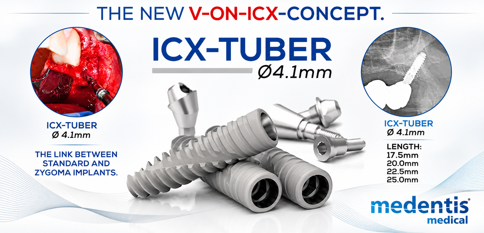 ICX-TUBER implant